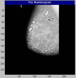 Segmentation and Detection of Micro Calcification Regions in Mammogram using Genetic Algorithm